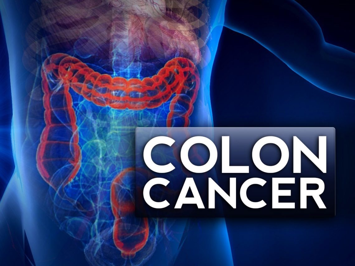 COLORECTAL CANCER ANALISI CATA CATANIA