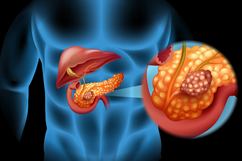 pancreas_ELASTASI PANCREATICA-ANALISI CATA CATANIA